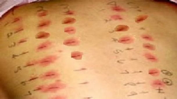 Passa 20 anni convinto di essere intollerante a tutto ma era allergico al cerotto del test - Lercio