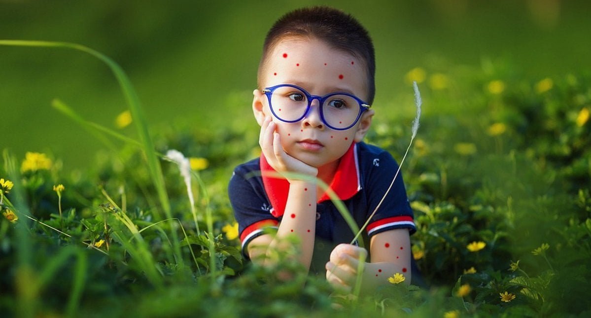 Mamma disegna puntini rossi sul corpo del figlio per farlo invitare ai morbillo-party - Lercio